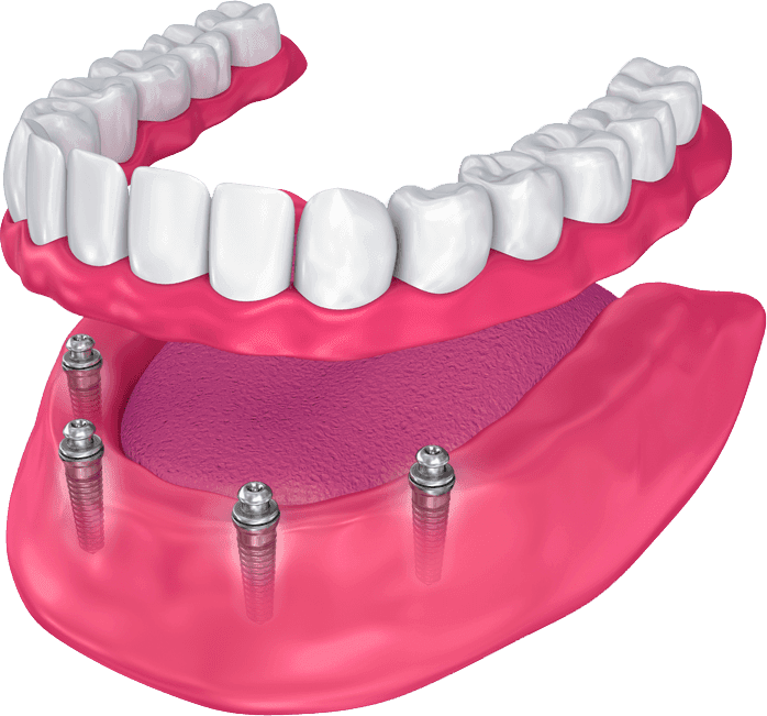 Modelo 3D de prótese dentária.